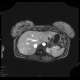 Focal nodular hyperplasia, liver, T1W portal phase: MRI - Magnetic Resonance Imaging